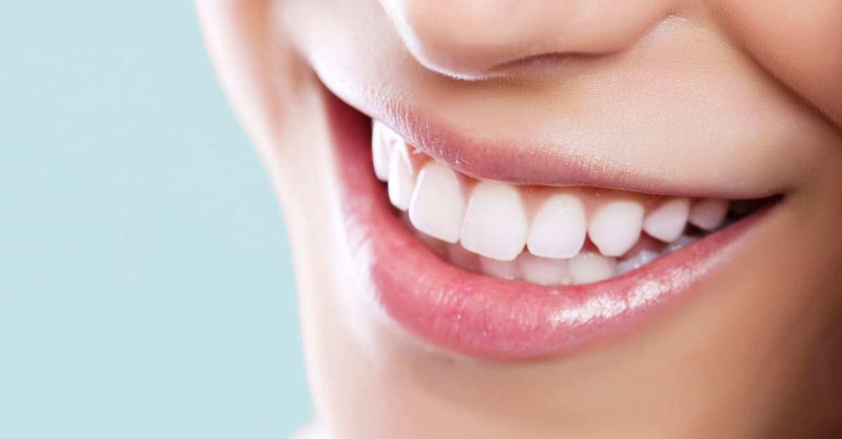 Bis zu 74% Rabatt auf den Bleaching – Beim Zahnarzt – Nicht markengeschützt bei Raquels Beauty